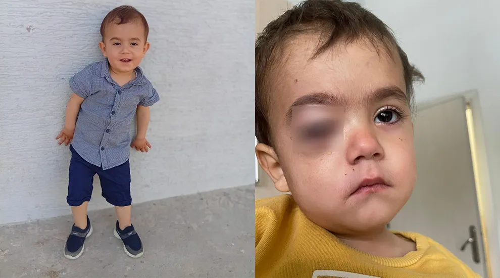 İnegöl’de Torpil Faciası: 2 Yaşındaki Alpaslan Gözünü Kaybetti